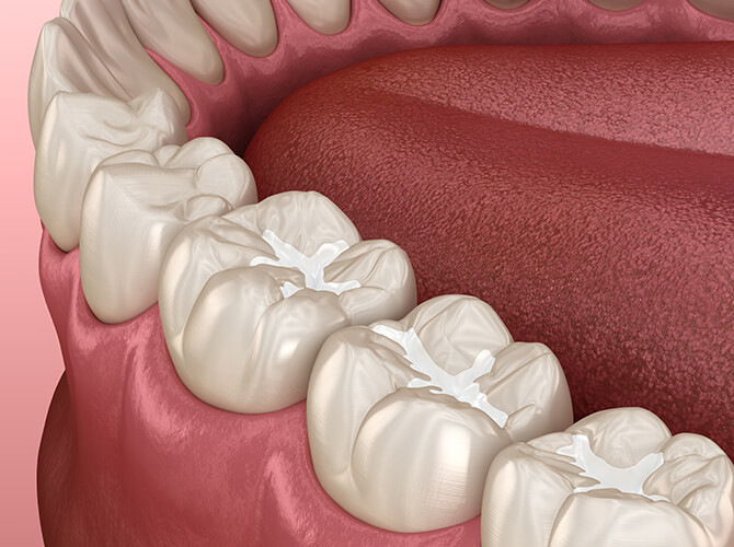 illustration of a tooth-colored filling